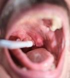 סרטן בפה ובגרון - תמונת אווירה